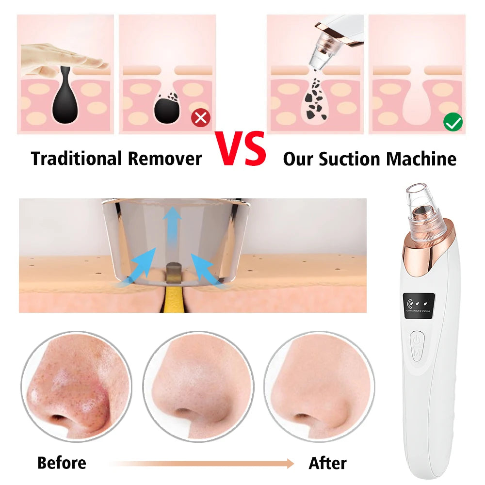 Blackhead Remover Pore Vacuum - USB Rechargeable Facial Pore Cleaner Kit