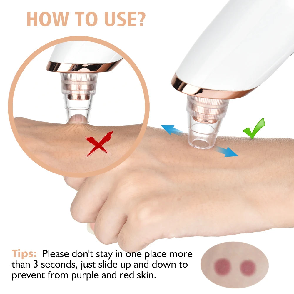 Blackhead Remover Pore Vacuum - USB Rechargeable Facial Pore Cleaner Kit