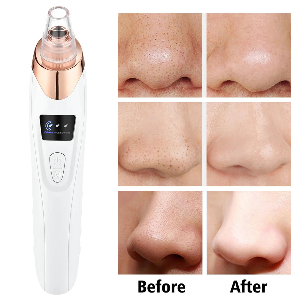 Blackhead Remover Pore Vacuum - USB Rechargeable Facial Pore Cleaner Kit